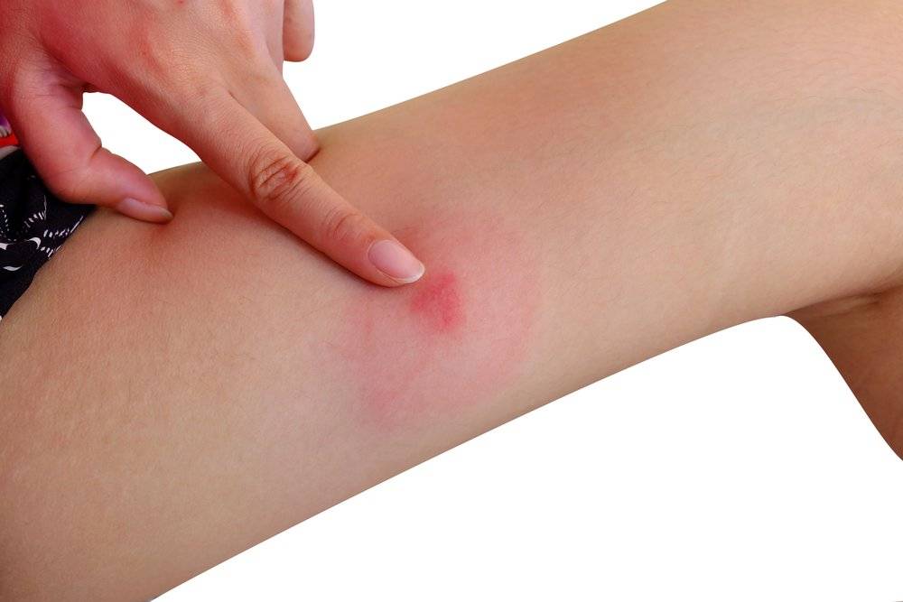 Симптомы аллергического отека на укус насекомого и их проявления