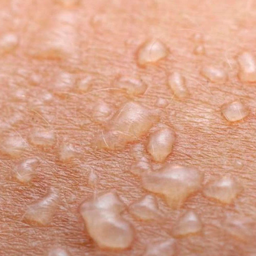 Водянистые образования на коже – причины, симптомы и лечение везикул на коже