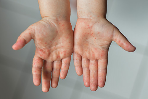 Почему у подростка потеют руки: причины и способы решения проблемы
