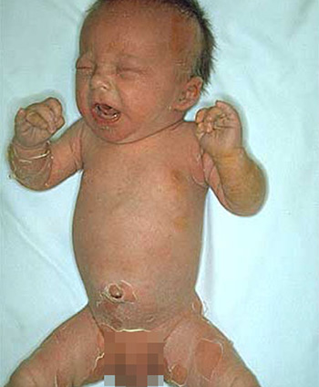 Воспаление кожи у новорожденного