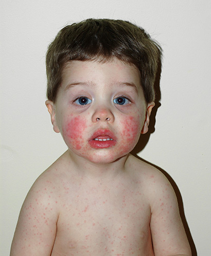 Красные щеки у ребенка и сыпь в виде сеточки