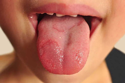 аллергия на языке у ребенка фото